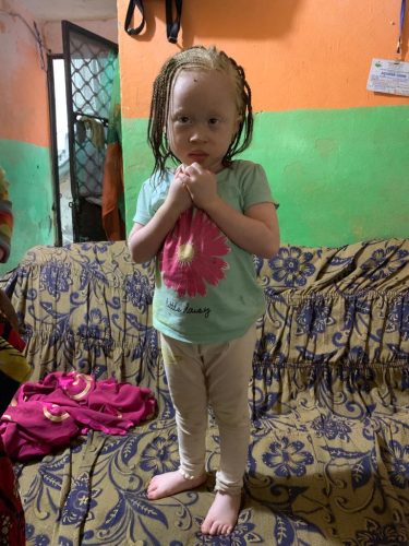 A-beautiful-shy-little-girl-with-albinism