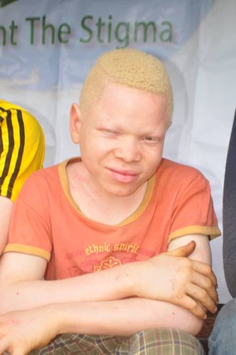 Boy-with-albinsim-smiling-at-the-camera-in-Cameroon
