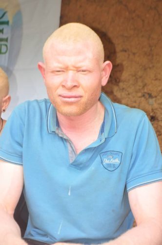 College-boy-with-albinism-in-Cameroon
