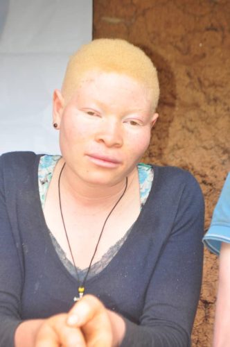 Girl-with-albinism-in-Cameroon