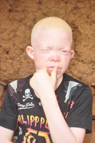 Inquisitive-boy-with-albinism-in-Cameroon