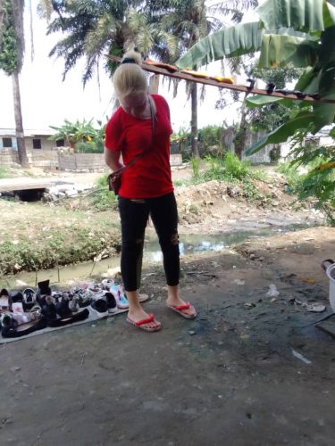 Albinism in Douala Cameroon