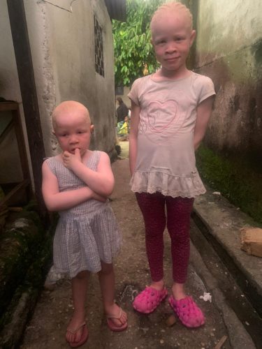 Beautiful young girls with albinism