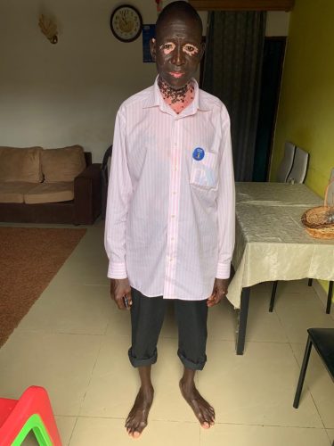 Man living in Douala with vitiligo