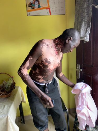 Man showing his body covered with vitiligo