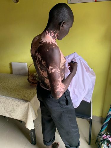 Man showing his body covered with vitiligo 