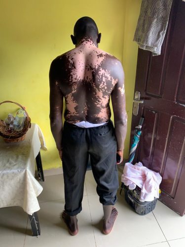 Man showing his body covered with vitiligo 1