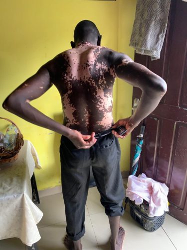 Man showing his body covered with vitiligo 2