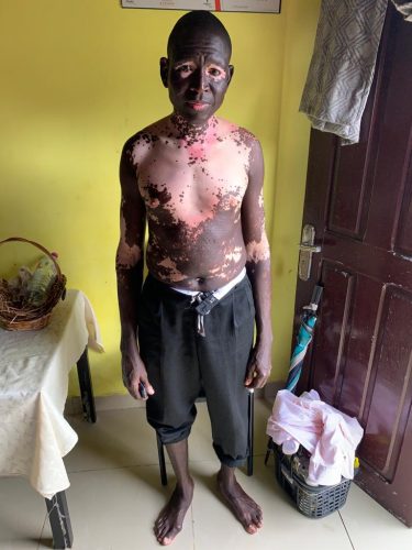 Man showing his body covered with vitiligo 3