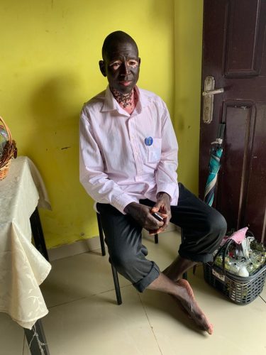 Man with vitiligo in Douala talking about his condition