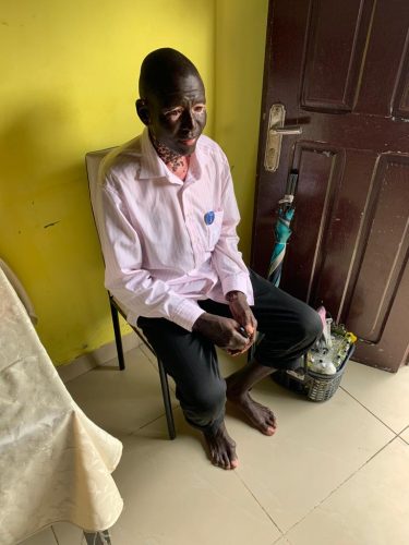 Man with vitiligo in Douala talking about his condition1