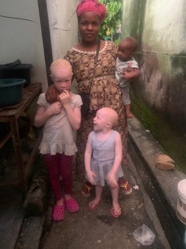 Mother and children with albinism