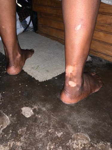 Person with vitiligo on legs