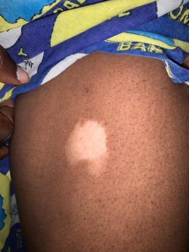 Signs on vitiligo woman