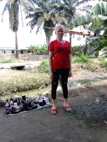 Woman with albinism in Douala