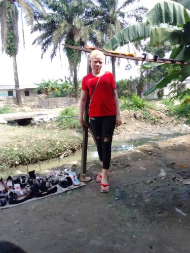 Woman with albinism showing her shoes collection