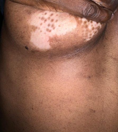 vitiligo on the breast